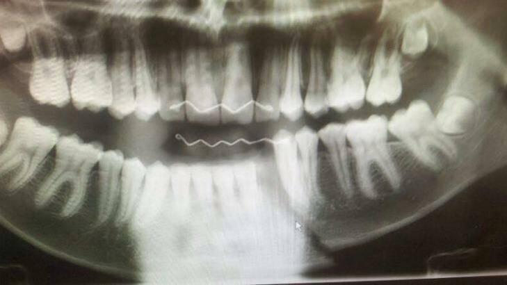 An x-ray showing the fractured jaw of a young soccer player who was injured in an on-field fight. Photo: Supplied